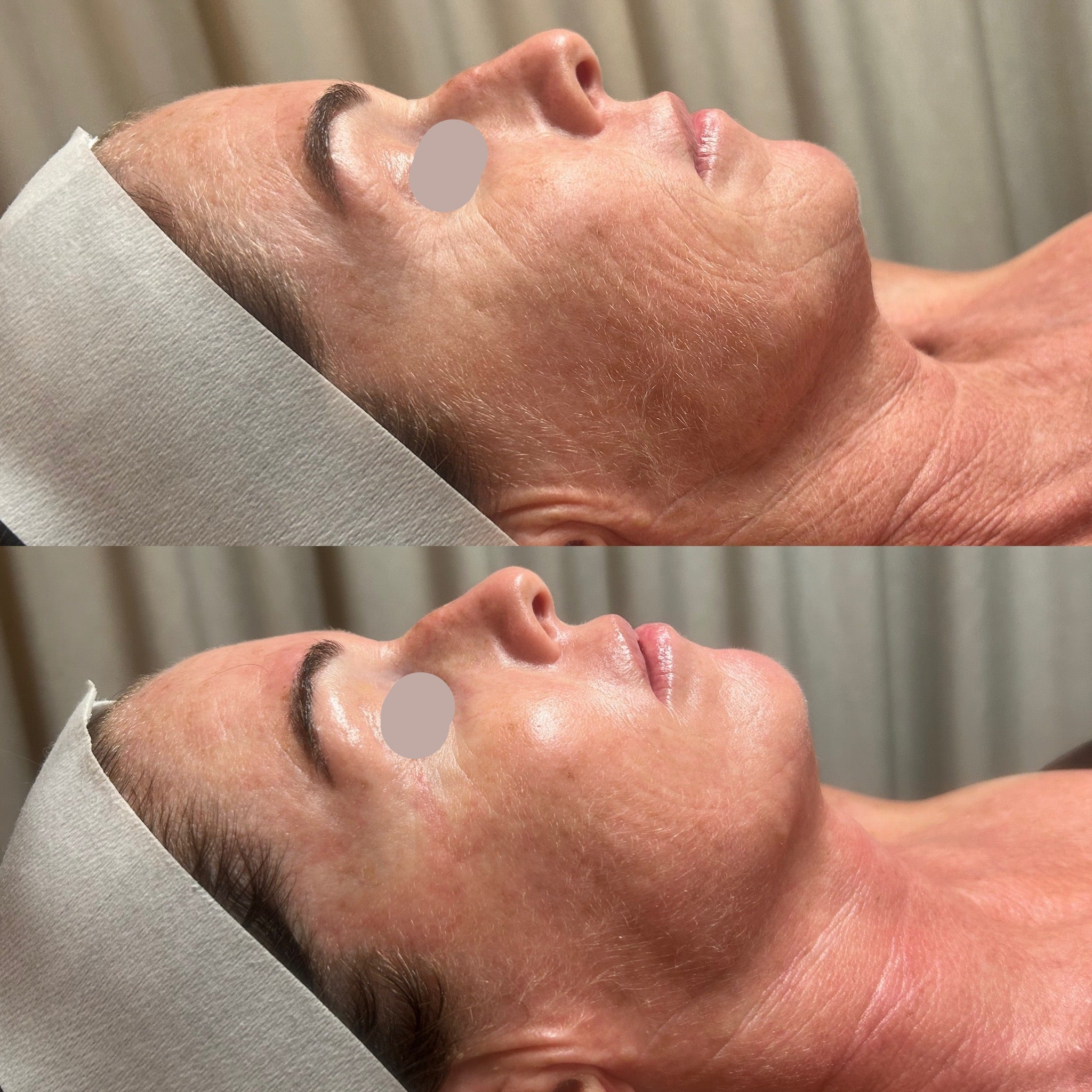 Before and after comparison of a person's face with a neutral background